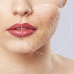 لیزر co2 فرکشنال