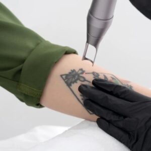 پاک کردن خالکوبی با لیزر کیوسوییچ